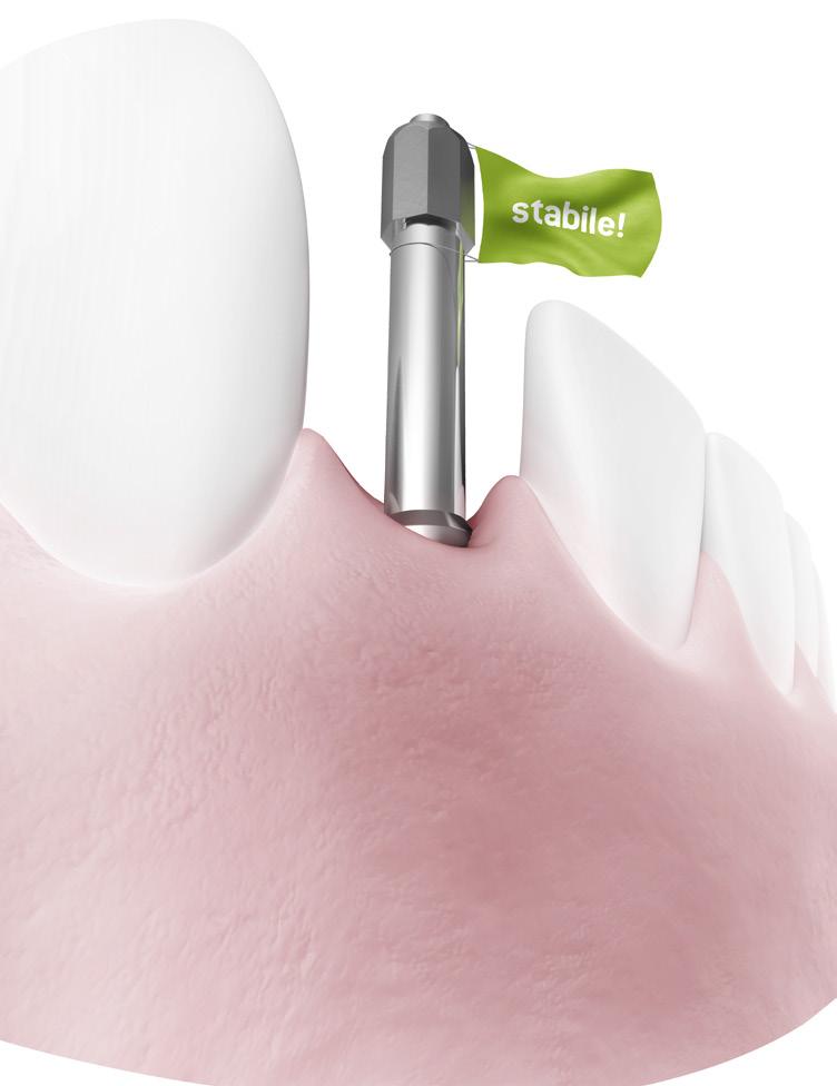 È un opzione importante per consentire osteointegrazione, sollecitazione immediata e applicazione protesica senza