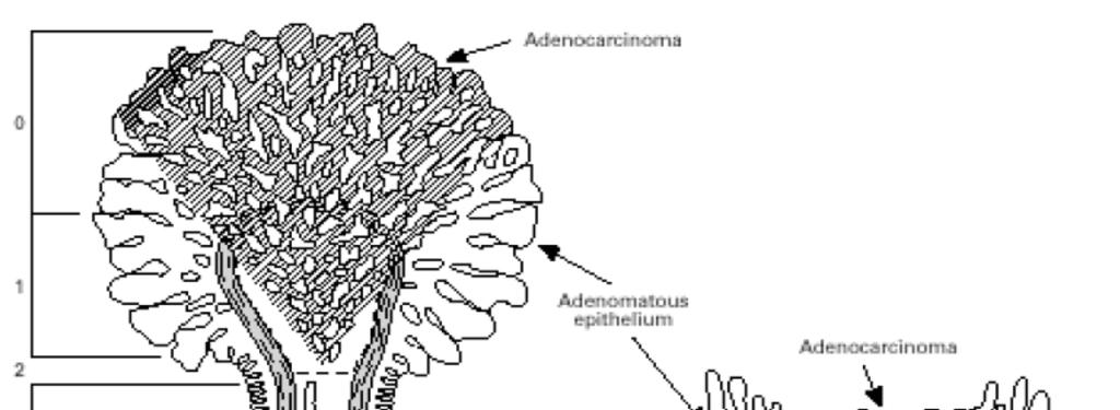 Adenoma cancerizzato: