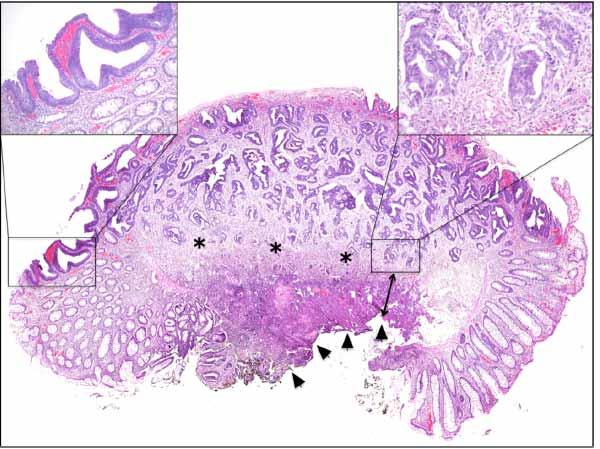 Adenoma cancerizzato: cosa è?