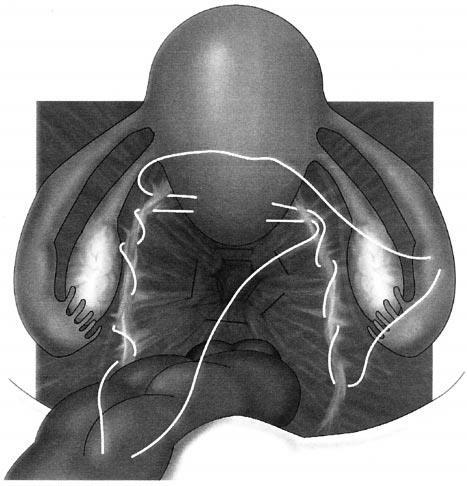 Laparoscopic suture hysteropexy for uterine prolapse