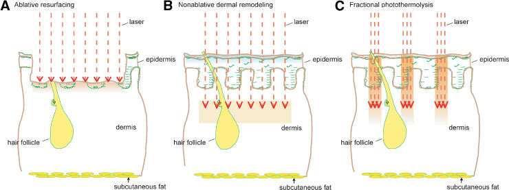 Diversi tipi di Fotoringiovanimento Laser Resurfacing