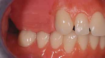 Figg. 98 e 99 Visione laterale e frontale della prova denti con controllo della correttezza della DVO e RC Fig.