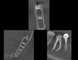 In questo caso, si dimostra estremamente utile data la cresta dell osso alveolare estremamente fine.