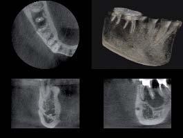 trattamento di lesioni periapicali Diagnosi Lavorare con la massima sicurezza Identificare denti inclusi o