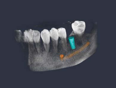 Un nuovo livello di precisione L acquisizione di immagini 3D, consente una visualizzazione precisa delle strutture dentali nella loro rappresentazione spaziale effettiva.