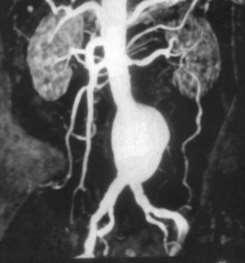 Criteri anatomici di selezione per EVAR (in parte modificati nel tempo!) 1.