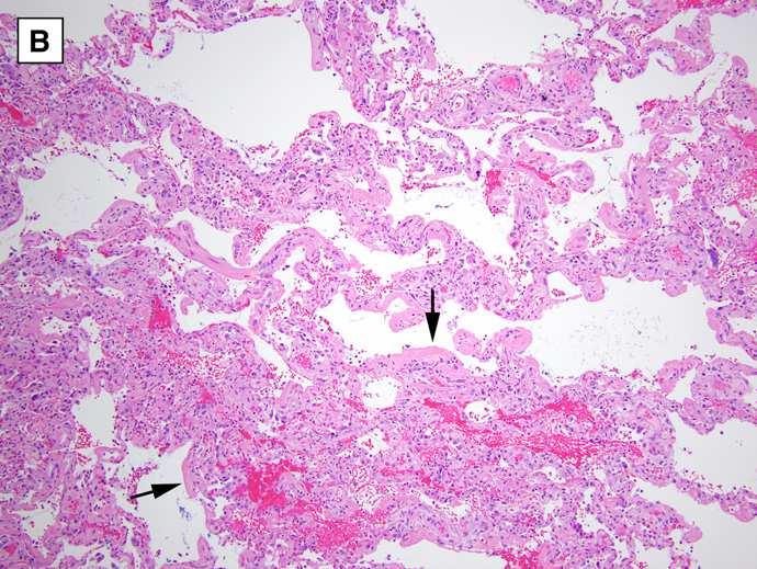 Pulmonary Fibrosis