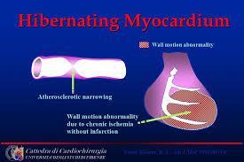 Rischio trombosi accesso Microinfarti, lacunae