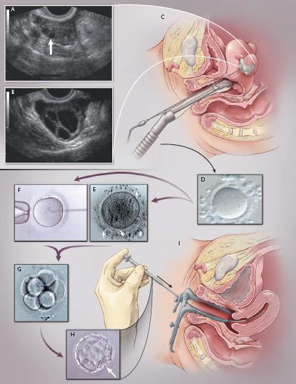 Tasso di natalità Dopo un ciclo di IVF solo il 34% delle