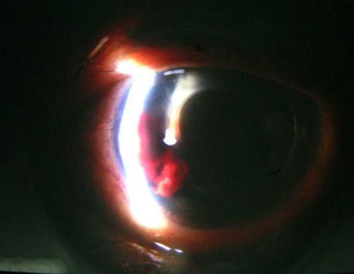 2001 La paziente, mentre si trovava sul balcone di casa riferisce di essere caduta urtando l occhio destro contro l apertura esterna del tubo rigido dell annaffiatoio.