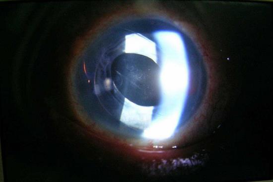 percezione della luce. Il tono oculare era di 32 mmhg (G). Nei giorni successivi il progressivo riassorbimento del sangue in C. A. portò al la normalizzazione del tono oculare.
