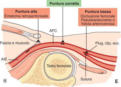 TECNICA DI SELDINGER Tale tecnica di cateterismo è la metodica più usata e prevede la puntura con aghi di diverso calibro muniti di mandrino e l