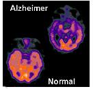 MALATTIA DI ALZHEIMER MALATTIA SENILE : colpisce 10% popolazione con età> 65 anni Progressiva