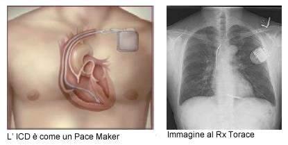 CRT terapia di resincronizzazione In un pacemaker convenzionale, quando si parla di stimolazione ventricolare si fa riferimento