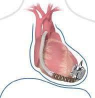 Assistenza ventricolare L-VAD (Left