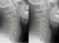 RETTILINEIZZAZIONE DELLA LORDOSI CERVICALE Se viste di profilo, le vertebre cervicali formano una leggera curva in avanti, che viene chiamata lordosi cervicale.