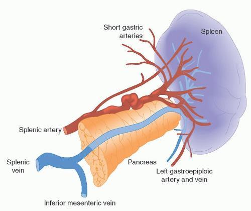 Pancreasectomia distale Leghiamo arteria splenica Interrompiamo i gastrici brevi Transezione