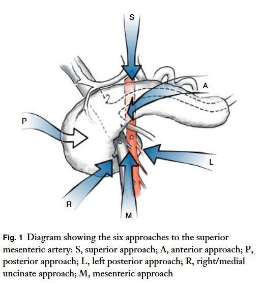 Artery First In letteratura sono descritti sei approcci 1 1- Sanjay P