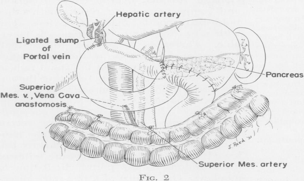 . A one-stage pancreatoduodenectomy with