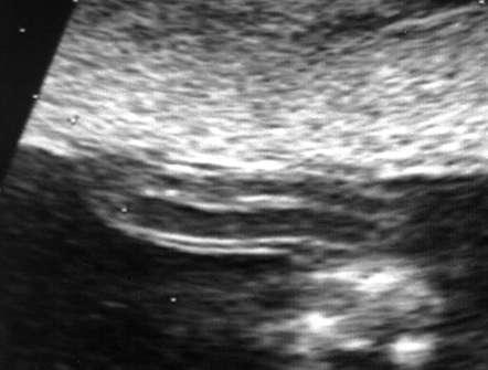 Trasfusione fetale intravascolare Visualizzazione dell