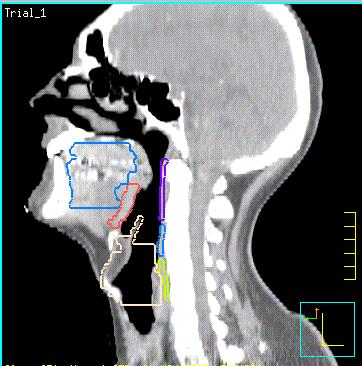 Strutture anatomiche: e relazione dose/volume Autore N pz Sede Tx Tempo Valut.