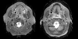 L IMRT risparmia strutture del distretto cervico-facciale come ghiandole salivari, laringe e midollo