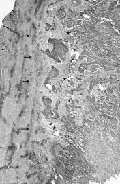 I carcinomi glottici La strategia chirurgica endoscopica attuata con il laser, in questi pazienti, ci ha consentito comunque di accertare la possibilità di effettuare l asportazione della neoplasia