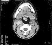 epiglottide. Fig. 2. T.C. della laringe co