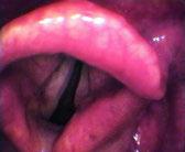 Edema bilaterale di grado grave delle corde vocali: a: lo