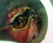 incisione della plica ariepiglottica di