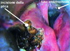 3. Identificazione della cartilagine aritenoide.