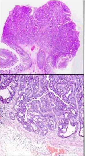 Adenomi cancerizzati: indicazioni GISCoR Parametri istologici utili per la decisione terapeutica (chirurgia radicale vs follow up) Grading Invasione linfo vascolare Budding