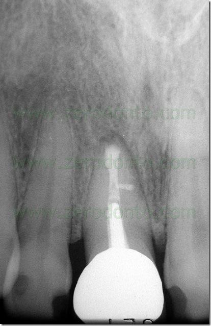 Per questo motivo si preferisce utilizzare il termine Endodonzia Chirurgica anziché Chirurgia Endodontica, in quanto l intervento deve essere programmato ed eseguito come un intervento di endodonzia