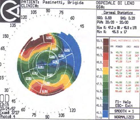 Gestione e controllo dei risultati topografia preoperatoria 3 gg dopo intervento VOD: