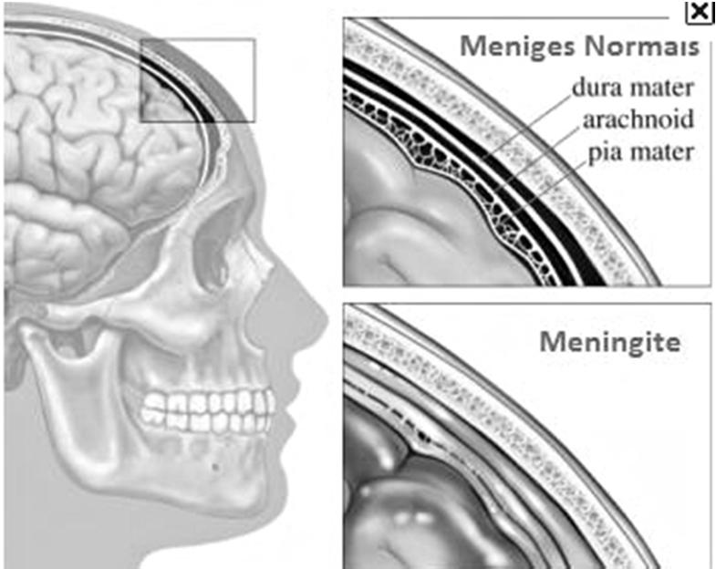 Meningite: definizione La meningite è un processo infiammatorio a livello delle leptomeningi (pia madre e aracnoide),