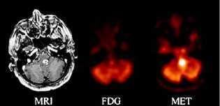 PET Encefalo Elevata captazione di FDG della sostanza grigia 11 C-methionine PET: - elevata sensibilità (75-95%) e specificità (80-100%) nella diagnosi dei gliomi - indicatore di prognosi - miglior