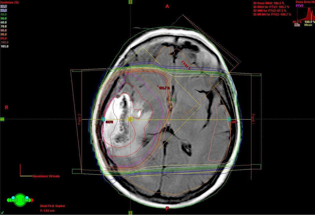 Encefalo Fusione CT-MRI