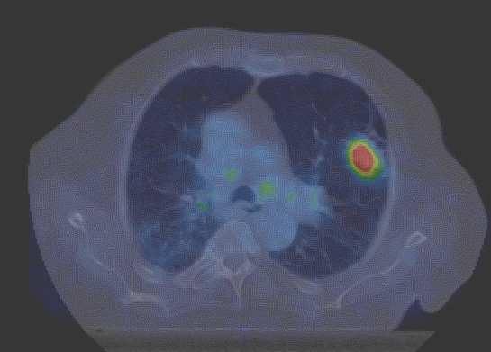 18 F-FDG FDG PET-CT :