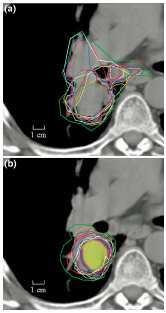 CT vs PET/CT Variazioni intra-interosservatore nella