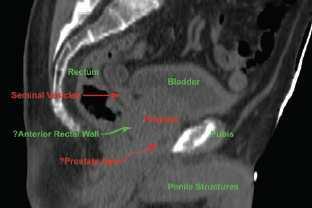 Prostata CT - T1/T2: non rilevabili - T3/T4: limiti nella valutazione di a) extracapsularità b) infiltrazione di vescicole