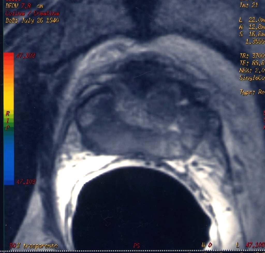MRS Prostata colina MRSI