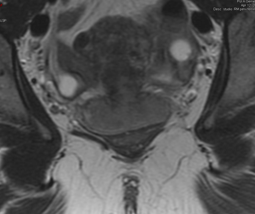 MRI Cervix -