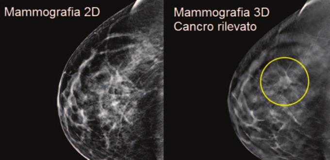 Un sistema mammografico diverso da qualsiasi altro. Il sistema è stato progettato per offrire una tecnica di tomosintesi mammaria rivoluzionaria.