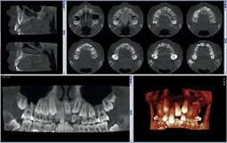 Il protocollo di imaging unico e pionieristico si basa su algoritmi 3D intelligenti sviluppati appositamente da Planmeca.