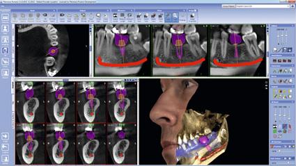 posizionamento dell impianto utilizzando modelli di impianto, corona e moncone realistici