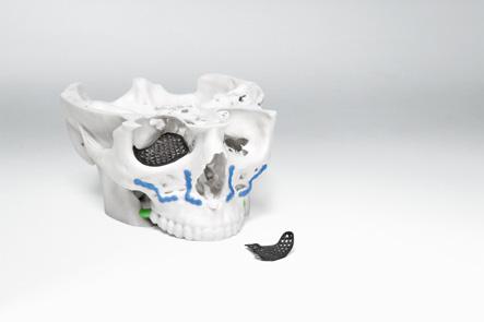 Modello del cranio per la pre-pianificazione chirurgica e l impianto
