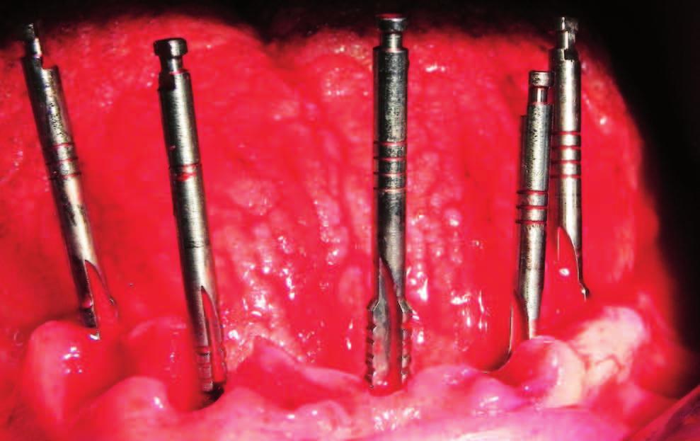 su radici dentarie e impianti; una serie di preparazioni dentarie con la applicazione di protesi inamo-rimovibili con attacchi di precisione (30 crediti ECM).