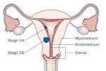 EPIDEMIOLOGIA Tumore ginecologico piu frequente IV tumore per incidenza 70-80% confinato utero 80% adenocarcinoma