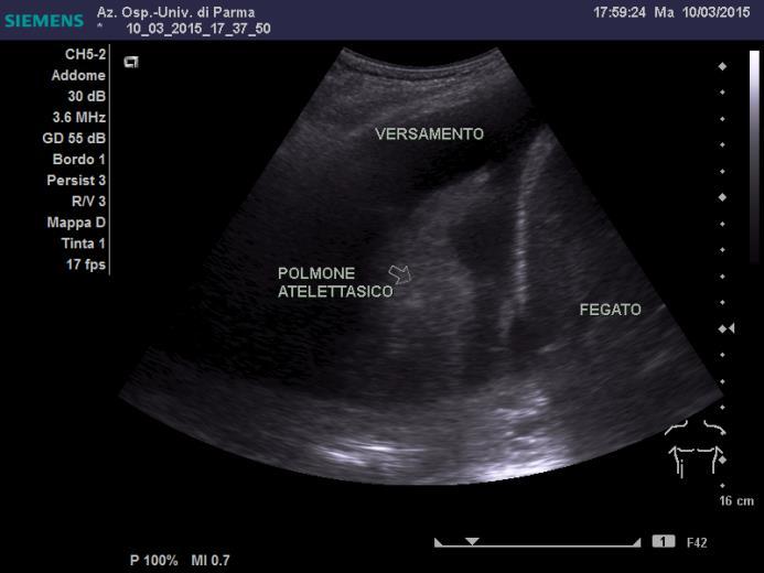 I segni ecografici di patologia polmonare sono stati ricercati ed interpretati secondo le linee-guida internazionali (Volpicelli G et al, Intensive Care Med 2012) Scansione