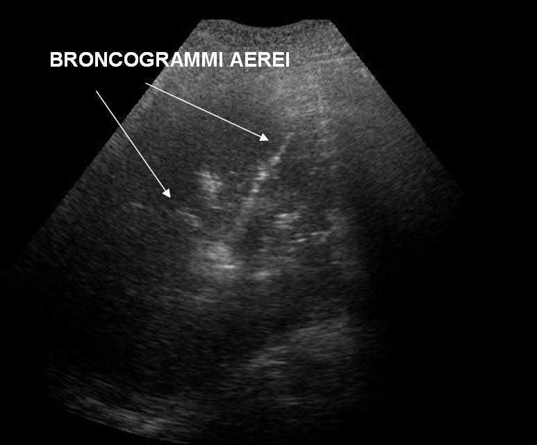 foglietti pleurici e linee B Versamento pleurico Spazio anecogeno fra i due foglietti pleurici, «lung pulse» Addensamenti flogistici Ecotessitura simil-parenchimale con